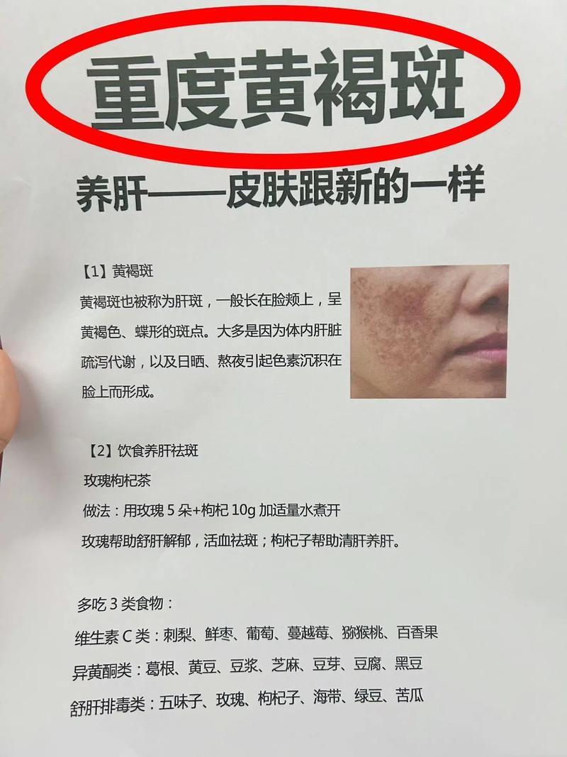 女人气血足了脸上还会长斑吗,女性气血足了后能淡面部黄褐斑吗